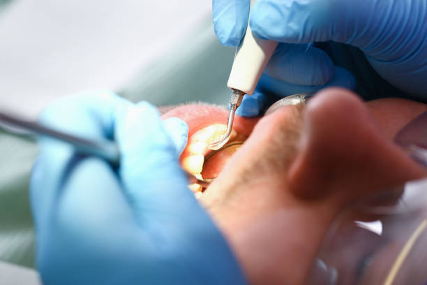 Best Emergency Wisdom Teeth Removal in Alexandria, KY